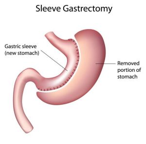 gastric sleeve